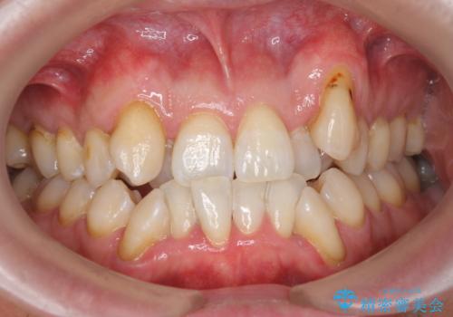 オフィスホワイトニングで、歯を白く口元イメージアップで爽やかに!!