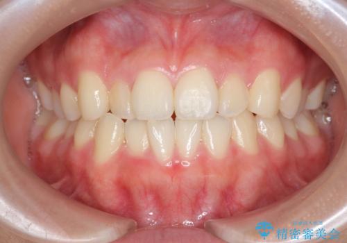 マウスピース矯正で前歯のガタつきを改善の症例 治療前