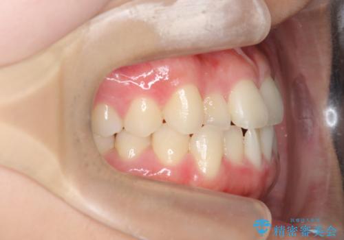 マウスピース矯正で前歯のガタつきを改善の治療前