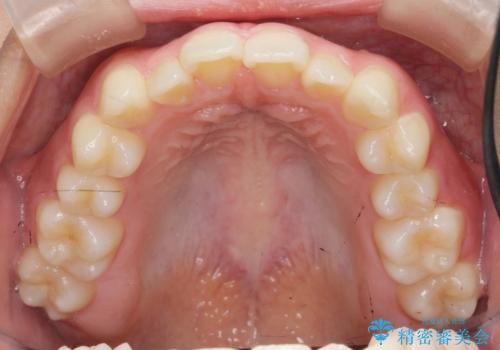 マウスピース矯正で前歯のガタつきを改善の治療前