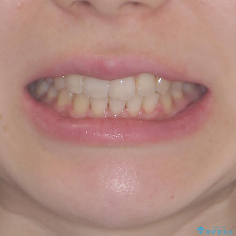 変則的な抜歯矯正 八重歯を抜いてしまった人のワイヤー矯正の治療後(顔貌)