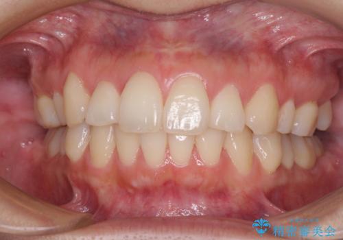 再矯正で突出した口元を引っ込める　抜歯矯正の後戻りの症例 治療前