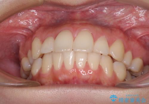再矯正で突出した口元を引っ込める　抜歯矯正の後戻りの治療前
