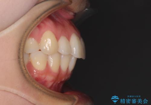 再矯正で突出した口元を引っ込める 抜歯矯正の後戻りの治療前