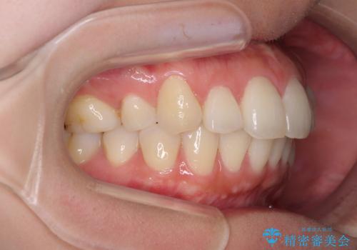 再矯正で突出した口元を引っ込める 抜歯矯正の後戻りの治療前