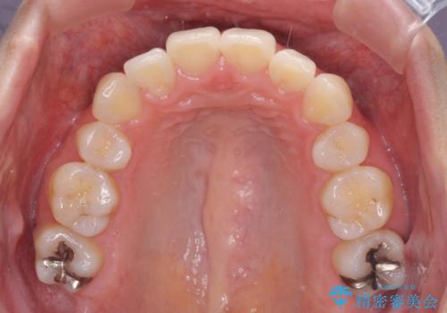 再矯正で突出した口元を引っ込める 抜歯矯正の後戻りの治療前