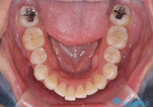 再矯正で突出した口元を引っ込める　抜歯矯正の後戻りの治療前