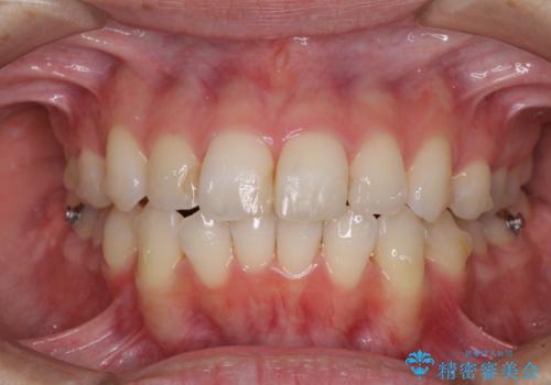 【モニター】前歯のデコボコをインビザラインできれいに整えるの治療中