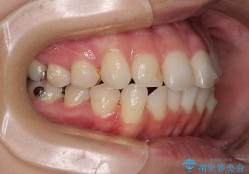 【モニター】前歯のデコボコをインビザラインできれいに整えるの治療中