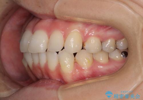 【モニター】前歯のデコボコをインビザラインできれいに整えるの治療中