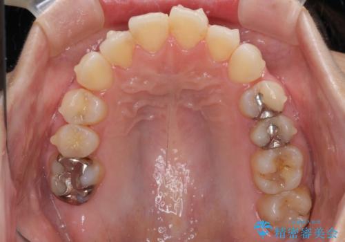 【モニター】前歯のデコボコをインビザラインできれいに整えるの治療中