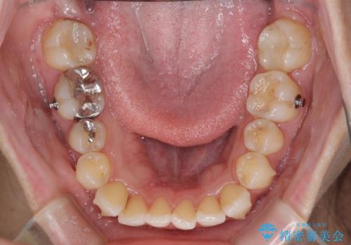 【モニター】前歯のデコボコをインビザラインできれいに整えるの治療中