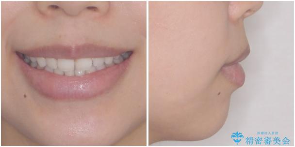 目立たない装置で横顔のシルエットを改善 ハーフリンガルでの抜歯矯正の治療後(顔貌)