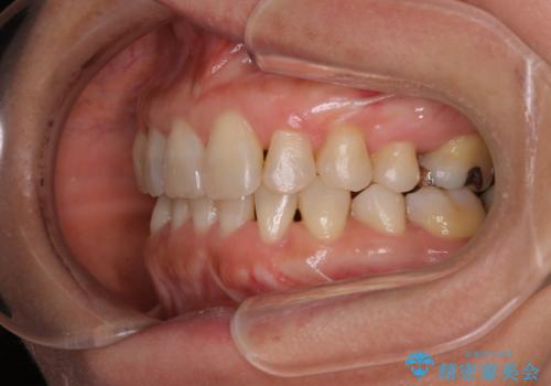 下の前歯が見えない:深い噛み合わせもインビザラインでの治療後