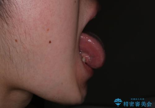 滑舌が気になる:矯正治療前に舌小帯切除の治療前