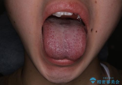 滑舌が気になる:矯正治療前に舌小帯切除の治療前