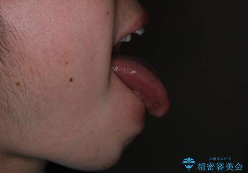 滑舌が気になる:矯正治療前に舌小帯切除の治療中
