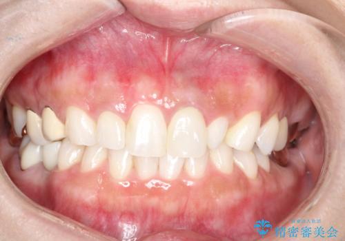 海外での被せ物 色が気になるの症例 治療後