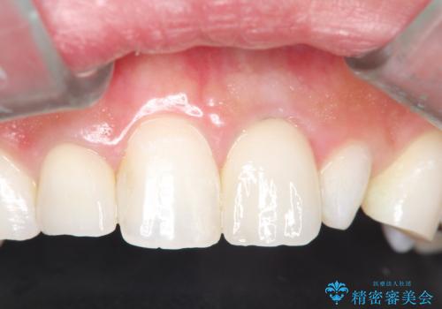 海外での被せ物 色が気になるの治療後