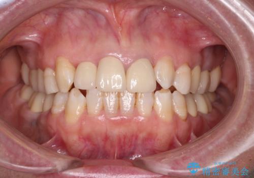 奥歯の銀歯と歯並びを改善　歯周外科治療と矯正治療を行った総合歯科診療の症例 治療後
