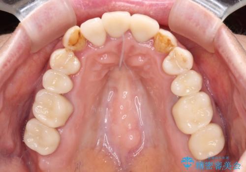 奥歯の銀歯と歯並びを改善　歯周外科治療と矯正治療を行った総合歯科診療の治療後