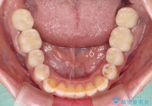 奥歯の銀歯と歯並びを改善　歯周外科治療と矯正治療を行った総合歯科診療の治療後
