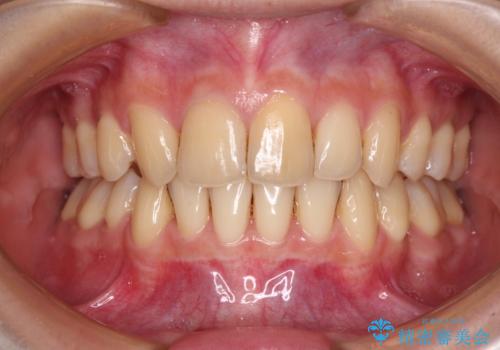 出っ歯を治したい ワイヤー装置による抜歯矯正の症例 治療後