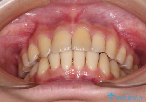 出っ歯を治したい ワイヤー装置による抜歯矯正の治療後