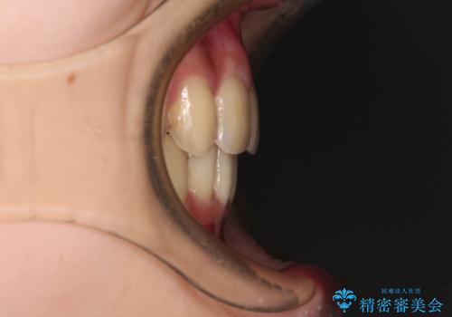 出っ歯を治したい ワイヤー装置による抜歯矯正の治療後