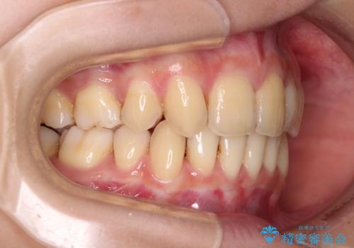 出っ歯を治したい ワイヤー装置による抜歯矯正の治療後