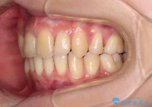 出っ歯を治したい　ワイヤー装置による抜歯矯正の治療後