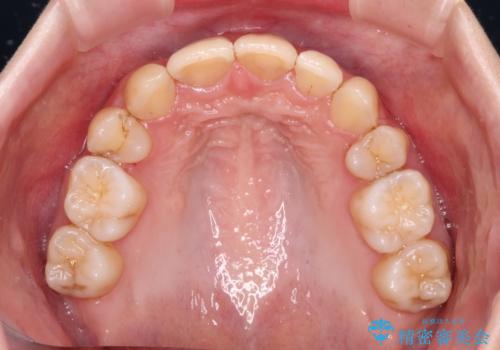出っ歯を治したい ワイヤー装置による抜歯矯正の治療後