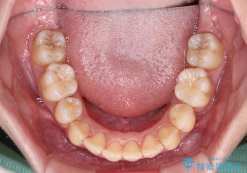 出っ歯を治したい ワイヤー装置による抜歯矯正の治療後