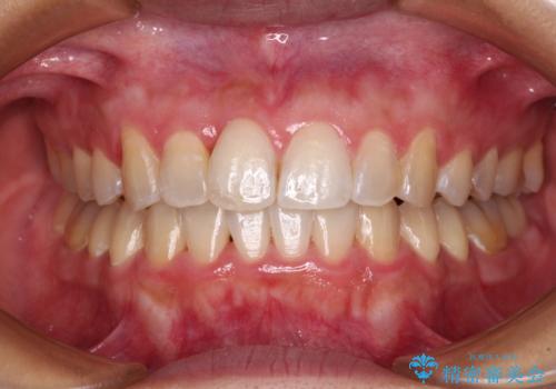 前歯のデコボコをインビザラインでスッキリと仕上げるの治療後