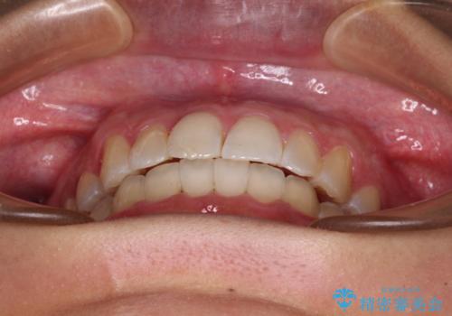 前歯のデコボコをインビザラインでスッキリと仕上げるの治療後