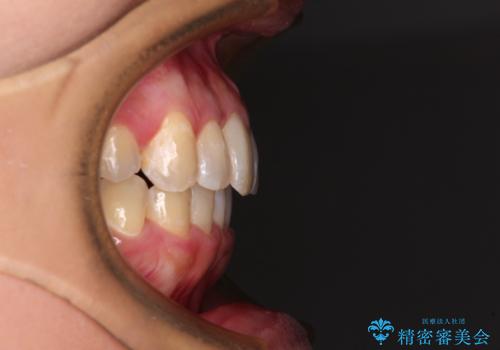 前歯のデコボコをインビザラインでスッキリと仕上げるの治療後