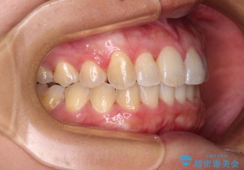 前歯のデコボコをインビザラインでスッキリと仕上げるの治療後