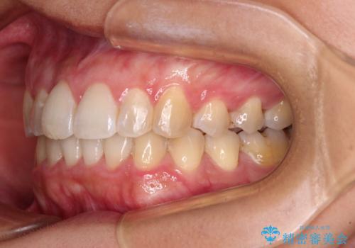 前歯のデコボコをインビザラインでスッキリと仕上げるの治療後