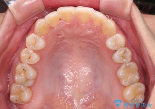 前歯のデコボコをインビザラインでスッキリと仕上げるの治療後