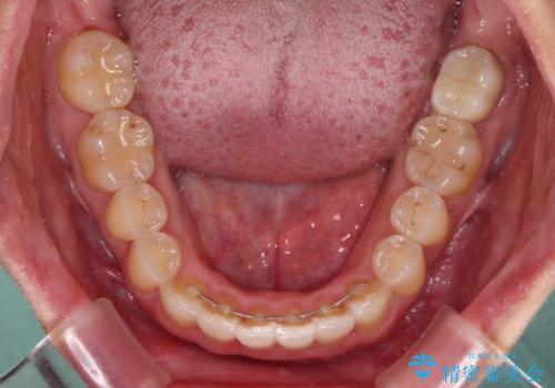 前歯のデコボコをインビザラインでスッキリと仕上げるの治療後