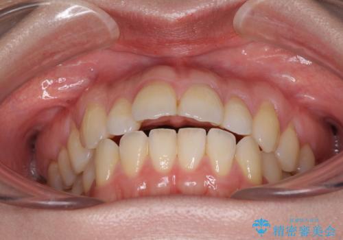 閉じにくい唇を抜歯矯正で閉じやすく 目だたないワイヤー矯正の治療前