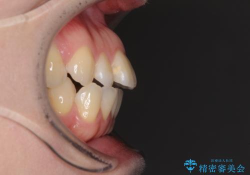 閉じにくい唇を抜歯矯正で閉じやすく 目だたないワイヤー矯正の治療前