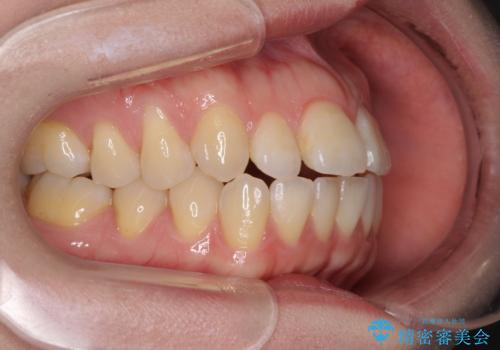 閉じにくい唇を抜歯矯正で閉じやすく 目だたないワイヤー矯正の治療前