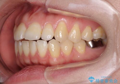 閉じにくい唇を抜歯矯正で閉じやすく 目だたないワイヤー矯正の治療前