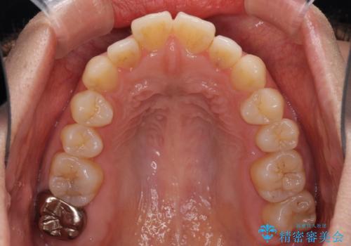 閉じにくい唇を抜歯矯正で閉じやすく 目だたないワイヤー矯正の治療前