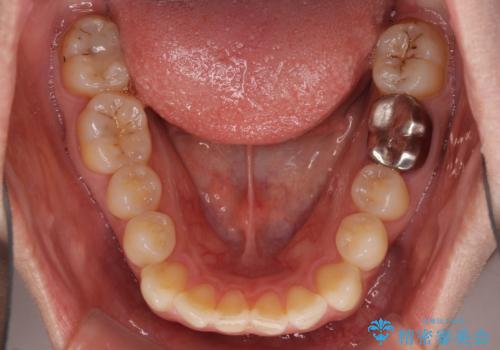 閉じにくい唇を抜歯矯正で閉じやすく 目だたないワイヤー矯正の治療前