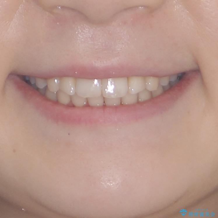 インビザラインを断念 ワイヤー装置で楽々と矯正治療の治療後(顔貌)