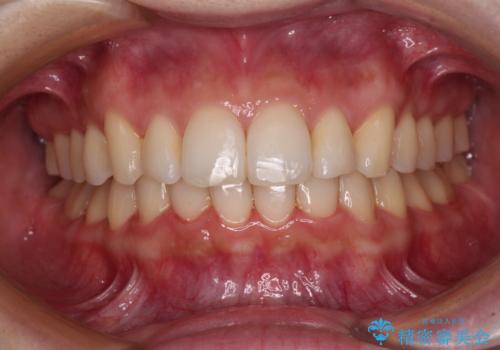 インビザラインを断念 ワイヤー装置で楽々と矯正治療の症例 治療後