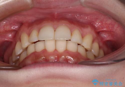 インビザラインを断念 ワイヤー装置で楽々と矯正治療の治療後