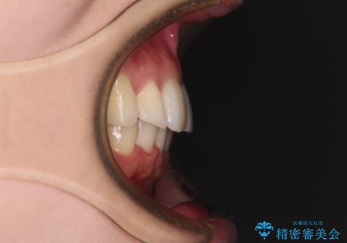 インビザラインを断念 ワイヤー装置で楽々と矯正治療の治療後